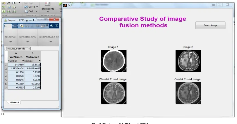 Fig.1.Fusion of MRI and CT Image   