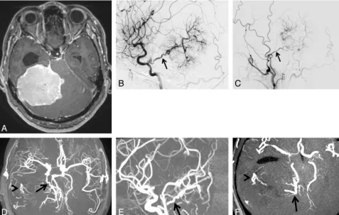 FIG 2. A 49-year-old woman with tentorial meningioma.tentorial artery at the medial portion of the tumor (( A, Axial contrast-enhanced 3D turbo ﬁeld echo image showing a large enhanced massin the supra- to infratentorial regions