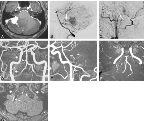 FIG 3. A 49-year-old man with cerebellopontine angle meningioma.pharyngeal artery (the right ascending pharyngeal (attachment was the cerebellopontine angle