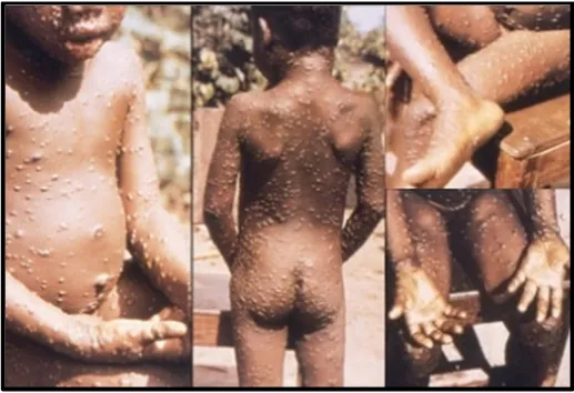 Figure 3.Figure 3. Monkeypox rash. Source: Centers for Disease Control and Prevention [ Monkeypox rash
