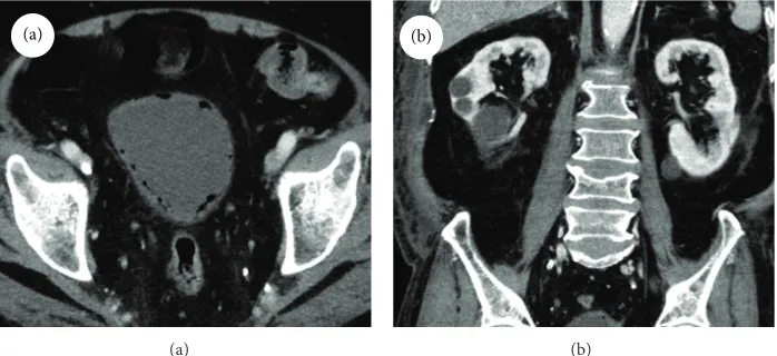 Figure 1: (a) Computed tomography of the abdomen showed multiple diffuse gas collection in the bladder wall suggestive of emphysematouscystitis