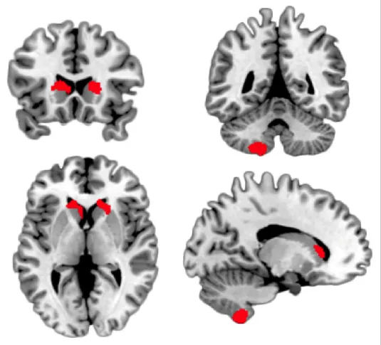 Figure 3. Brain regions showing a significant regression path from brain voxel to the latent slope of alcohol use score increase over time
