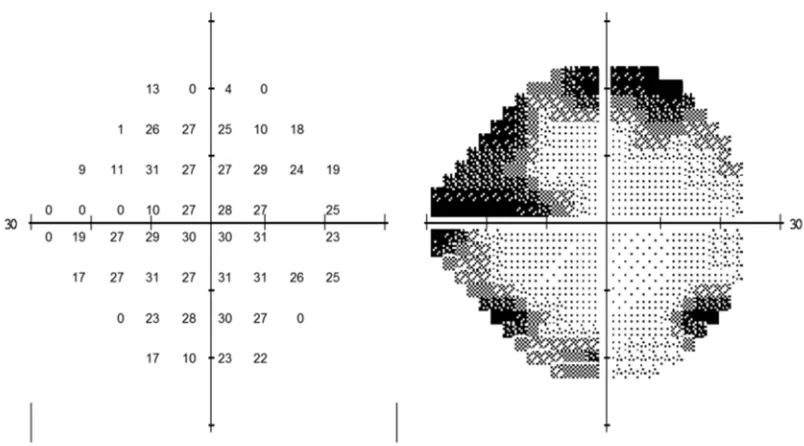 Figure 1.6 – Output from a Visual Field (VF) examination from a patient’s right eye.   The left grid shows the measured threshold sensitivities at 52 locations (excluding the blind spot), whereas the right grid is a greyscale with darker areas representing