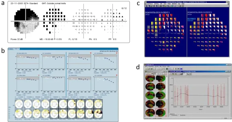 Figure 1.9 – A range of analytical tools available for use in clinical practice a) Statpac 2’s Glaucoma Probability Analysis for the HFA, b) Eyesuite Analysis software for the Octopus perimeter, c) Progressor and d) Peridata’s boxplot trend analysis 