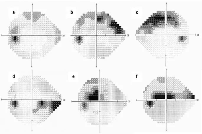 Figure 1.10 - HFA greyscale representations of six different eyes.   Clearly all the VF defects are different and might impact on the patient’s day-to-day function differently