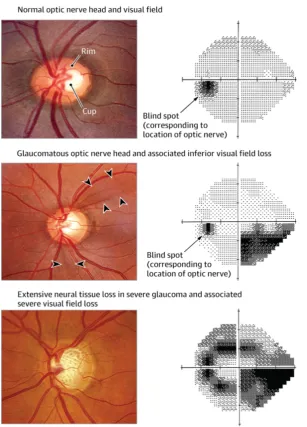 Fig. 1.1. Normal, glaucomatous, and severe glaucomatous optic nerve heads 