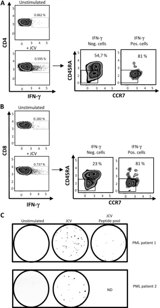 FIG 1 Detection of JCV-speciﬁc effector memory T cells (TEM) in blood of two natalizumab-treated patients with PML