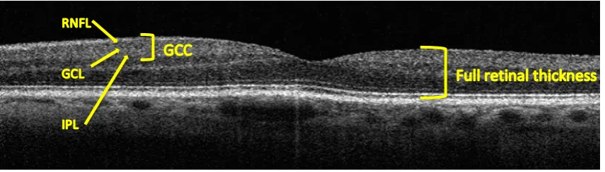 Figure   1.2:   Segmentation   of   the   ganglion   cell   complex   (GCC)   layer   comprised   of   the   retinal   nerve   fibre   layer   (RNFL),   ganglion   cell   layer   (GCL),   and   inner   plexiform   layer   (IPL)   