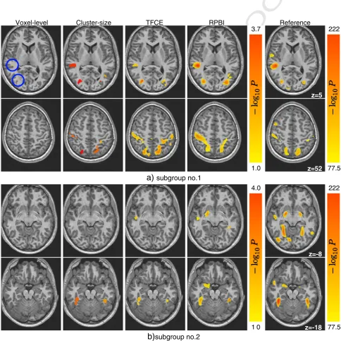 Fig. 6. Negative logp-value associated with a non-zero intercept test with confounds (handedness, site, sex), on a [angry faces–control] fMRI contrast from the faces protocol