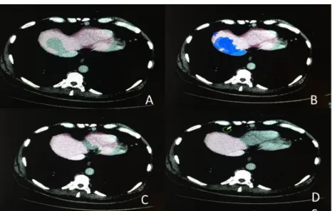 Figure 1: An example of the liver volume calculation. Theliver is highlighted pink on the cross sectional slices (rightcolumn) and cross sectional areas are then summed to forma 3D liver model and volume calculation.
