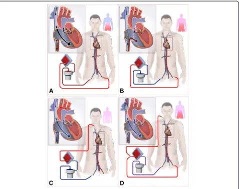 Figure 5 Paradigm depicting the mechanism of differential oxygen return. (A) Differential venous oxygen return between the IVC and the SVCexists in IVC-FA