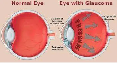 Figure 1: Normal and Glaucomatic eye 
