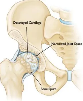 Figure 2.2.3: Hip joint with osteoarthritis (AAOS 2011) 