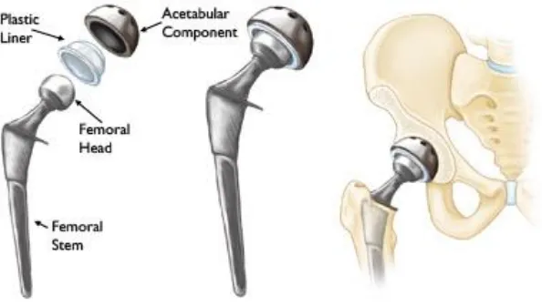 Figure 2.3.1: Total Hip Replacement. (Left) individual component; (Centre) the components merged into an implant; (Right) the implant fits into human hip