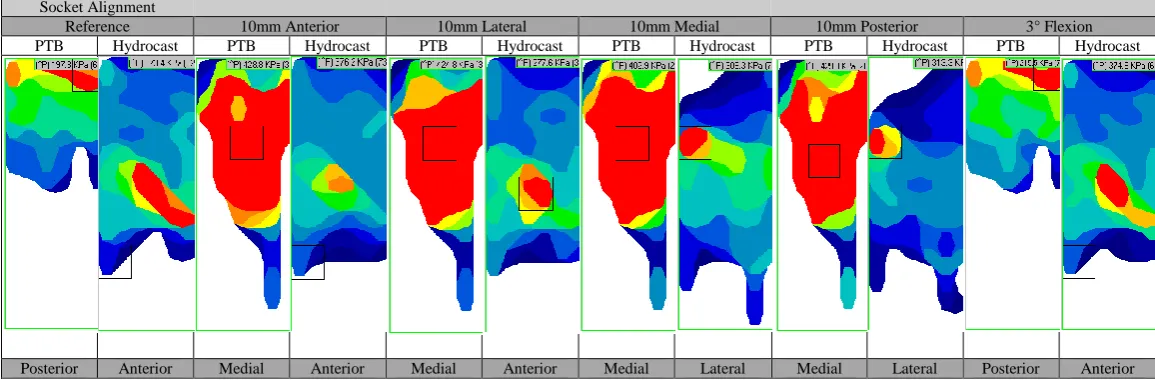 Figure 2. Residual limb-socket mean interface pressures at reference alignment and at an offset of 10mm posterior in PTB socket