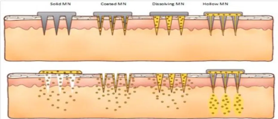 Figure 2: Different types of microneedles: solid, coated, dissolving and hollow. 