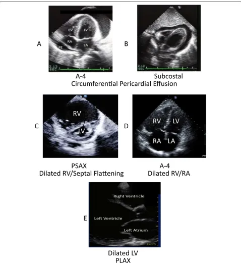 Figure 3 Examples of pathological findings. (A) Apical four chamber (A-4) view. Circumferential pericardial effusion