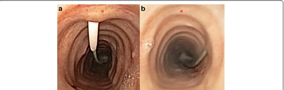 Figure 4 Bronchoscopic views. Appropriately positioned tracheal puncture (a) and an example of extremely lateral puncture with potential forcomplications (b)