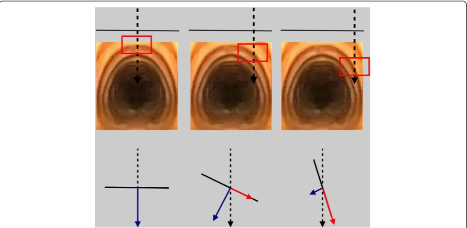 Figure 5 Risk associated with lateral tracheal puncture. Downward force (dashed black arrow) applied during dilation of the tract can bebroken up into force vectors which are perpendicular (blue arrow) and parallel (red arrow) to the tracheal wall (black l
