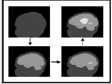 Fig 2.2 Brain Tumor Segmentation and Clustering 