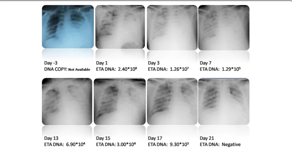 Figure 2 Dynamic changes on computed tomography scans for human adenovirus type 55 pneumonia in patient 3