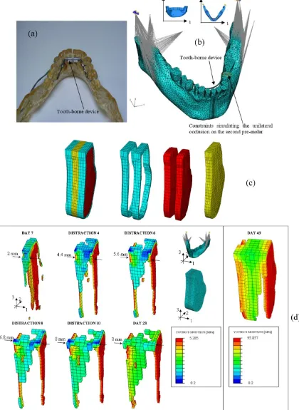 Figure 7: (a) Epoxy resin model - built with Rapid Prototyping techniques - of the mandible with a tooth borne distraction device; (b) FEM model of the mandible with the tooth borne device and boundary and loading conditions adopted