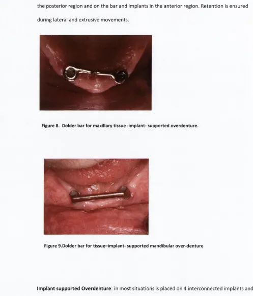 Figure 8. Dolder bar for maxillary tissue -implant- supported overdenture.