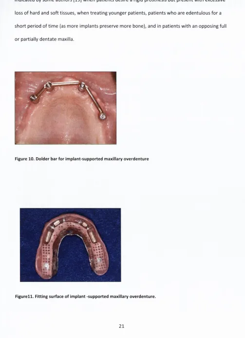 Figure 10. Dolder bar for im plant-supported maxillary overdenture