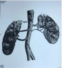 Figure 1. 3D reconstruction computerized tomography (CT) scan of a live renal donor depicting multiple renal arteries of both kidneys
