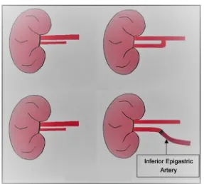 Figure 2. Schematic representation of the methods used in our study for vascular recon-struction of renal allografts with multiple renal arteries