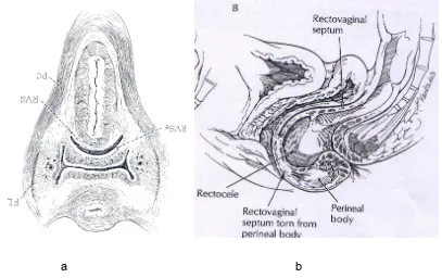 Figure 2.1 a, Cross-sectional view in axial plane of midvagina showing loop of pubococcygeus (PC), rectovaginal septum (RVS), fascia of levator (FL), chapter 1, p23; b; sagittal view of posterior compartment, chapter 11, p260