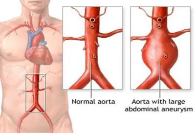 Figure 2.1 A diagram of the abdominal aorta in situ, comparing a normal aorta versus an aorta 