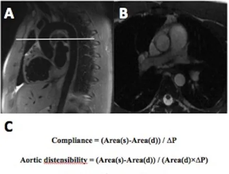 Figure 1. A–B. Scout cardiovascular magnetic resonance image ofd) = diastolic area,thoracic aorta demonstrating the planning of a transverse sectionthrough proximal descending aorta at the level of the right pulmonaryartery