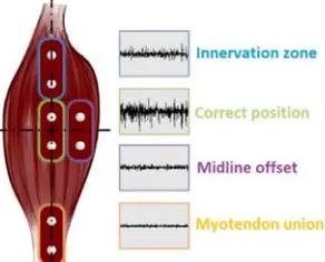 Fig. 3. MyoWare sensor positioning scheme 