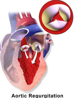 Figure 6.  Aortic regurgitation. During diastole blood flows from the left atrium into 