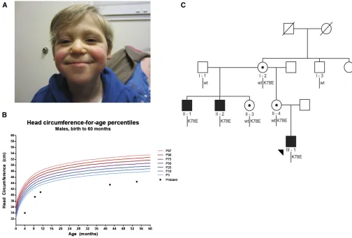 Figure 1 Microcephaly in an X-linked pedigree harboringa three-generation pedigree. Subsequent to identidiagnostic panel, Sanger sequencing con RPL10 p.K78E