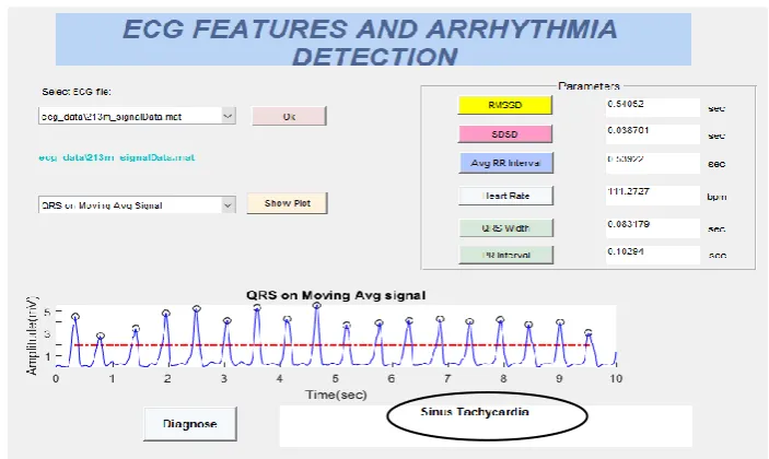 Fig. 6 Parameter Calculation and Arrhythmia Detection 