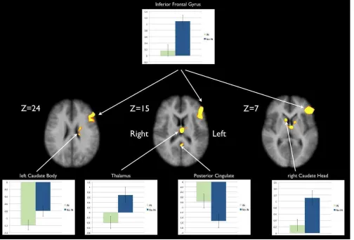 Table 1: Details of Scenario 1 activations, including their anatomic label, location, Brodmann Area (BA), eﬀect size and volume.