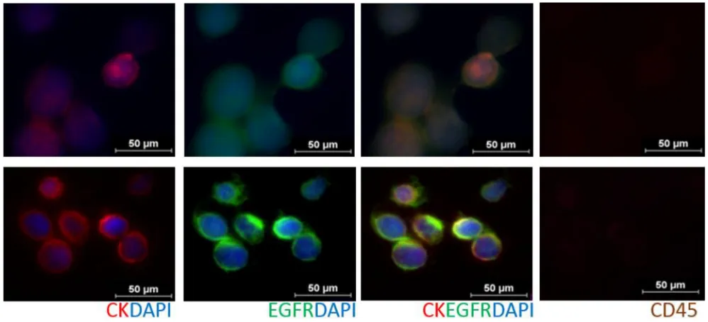 Figure 1: Immunofluorescent staining of CTCs from RosetteSep™ enrichred head and neck cancer patient blood samples (Row 1: Pt #10, Row 2: Pt #17), stained with an antibody cocktail (Cellsearch®: anti-Cytokeratin 8/18/19, DAPI, anti-CD45) and anti-EGFR