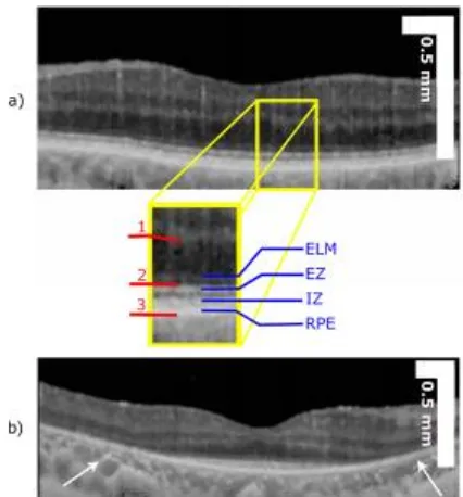 Fig. 1: An OCT B-scan of a healthy (a) and RP (b) affected retina after conversion to attenuation coefficient (see  section III-A)