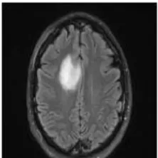 Fig. 1 Brain Tumor Image  