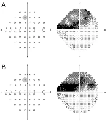 Figure 2. Ground-truth VF (A). The left hand grid of numbers illustrates pointwise sensitivity for all 52 locations in the VF, while the right handimage shows the corresponding grayscale plot