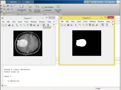 Figure9: MATLAB output for stage 4 tumor 