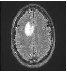 Fig. 1 Brain Tumor Image 