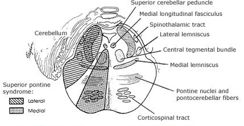 Figure 5. Superior pontine syndrome 