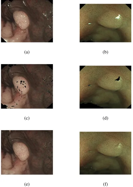 Fig. 3: Above the three pre-processing steps are shown: Theresult of ﬁnding the region of interest of the example imagesintroduced in Figure 1 can be seen in (a) for an adenomatousand (b) a hyperplastic polyp