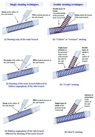 Figure 2. Considered bifurcation stenting techniques and they effect on stent strut