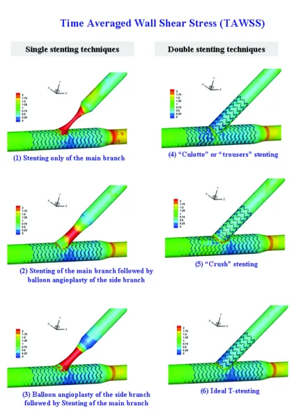 Figure 3. Time averaged wall shear stress (TAWSS) distribution at the bifurcation for the