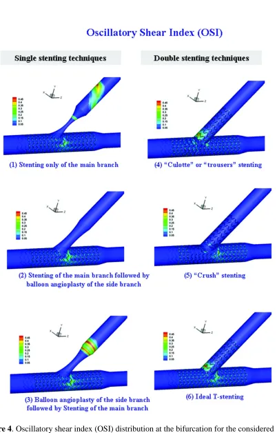 Figure 4. Oscillatory shear index (OSI) distribution at the bifurcation for the considered