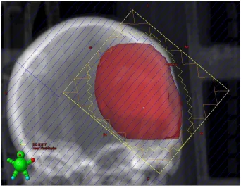 Figure 2: An MLC can form a shape that resembles the shape of the tumor.
